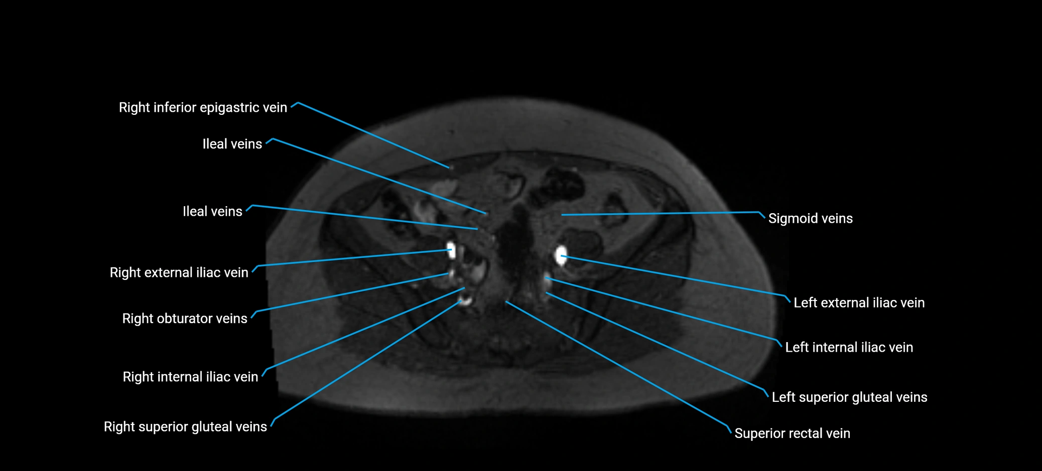 MRV abdomen pelvis & lower limb axial cross sectional anatomy labelled MRI image 139 (1).webp